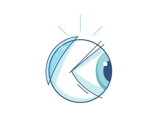 Kính áp tròng nằm ở phần sau mắt